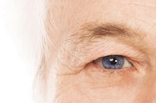 szemhéjplasztika Budapesten